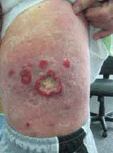 Figure 1. Lesions on the
patient's trunk