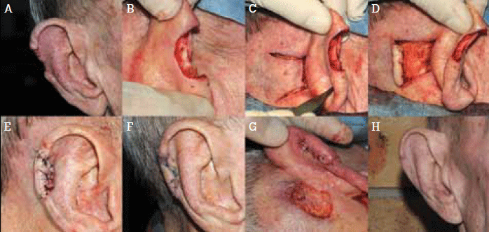 Figure 1. Repair of a full thickness surgical defect of the helical rim using a
retroauricular skin flap