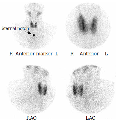 Figure 1. Normal thyroid scan, displayed in
standard projections
RAO = right anterior oblique
LAO = left anterior oblique