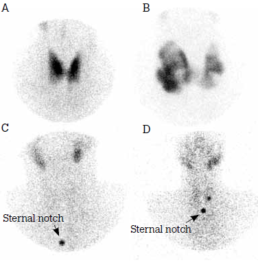 Figure 2. Typical scan appearances of common
causes of thyrotoxicosis A) Graves disease;
B) Multinodular goitre; C) Thyroiditis; D)
Autonomous nodule