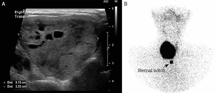 Figure 3. Autonomous right lobe nodule. A large nodule (measuring over 5 cm in
maximum dimension) was identified on ultrasound (A). The thyroid scan (B) showed it
to be hyperfunctioning
