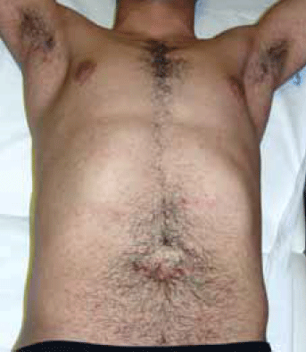 Figure 1. Scattered excoriated papules
over the trunk and axillary folds