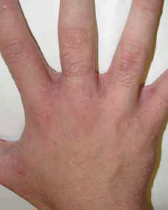 Figure 2. Scabby plaques in the
interdigital web spaces of the hands