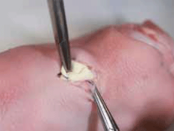 Figure 5. Sebaceous cyst excision on model