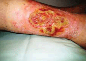 Figure 9. Chronic sloughy wound on patient