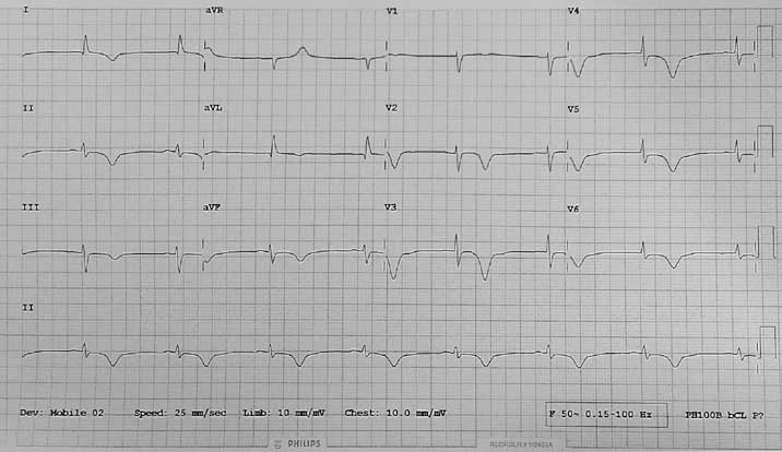 Figure 1. ECG showing deep T-wave inversion in all leads