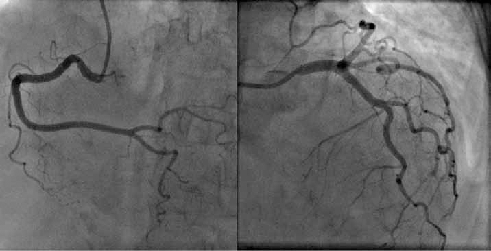 Figure 2. Angiogram showing normal coronary arteries