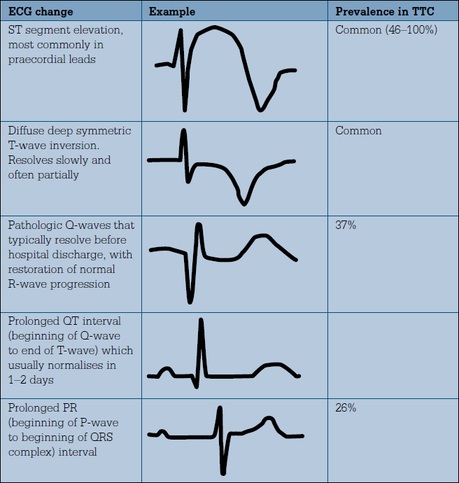 Figure 3. ECG changes in takotsubo cardiomyopathy (TTC)14
