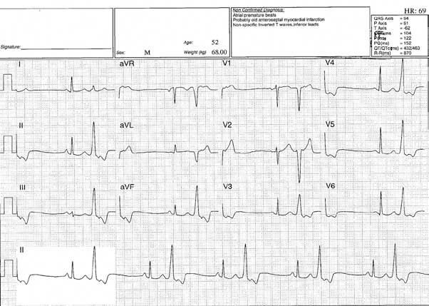 Figure 2. ECG from a general practitioner. The GP described this a ST segment depression,
interpretive function determined the key finding to be atrial premature beats and
the cardiologist diagnosed ventricular bigeminy