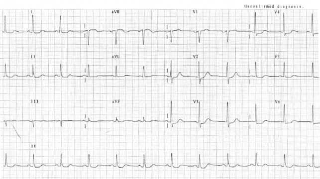 Figure 3. ECG with ST segment depression in leads V3–V6, I, II and reciprocal elevation
in aVR. This ECG was described as normal by the GP