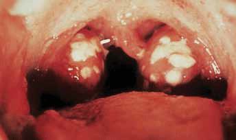 Figure 1. Acute streptococcal pharyngitis
Image © Elsevier 2003. Reproduced
with permission. Forbes CD, Jackson,
WF. Acute streptococcal pharyngitis.
Published in Color Atlas and Text of
Clinical Medicine, 3rd edn