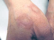 Figure 1. Ringed lesions with raised margins on dorsum of hands