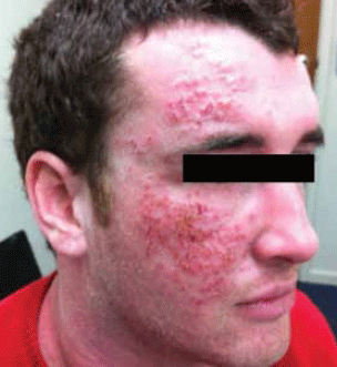 Figure 1. Facial rash on patient