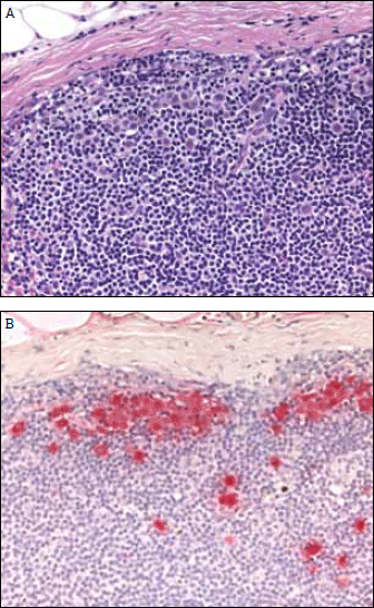 Figure 2. Melanoma metastasis in a sentinel lymph node