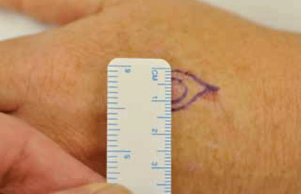 Figure 13. Measuring the lesion and margins