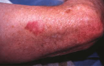 Figure 2. Superficial BCC on the arm