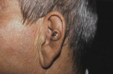 Figure 4. Well defined and well differentiated SCC of the ear