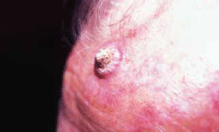 Figure 5. Rapidly growing keratoacanthoma with a central keratin core
