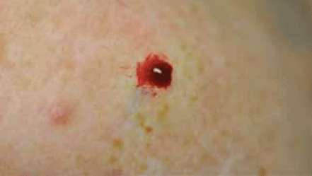 Figure 8. Bleeding after shave biopsy