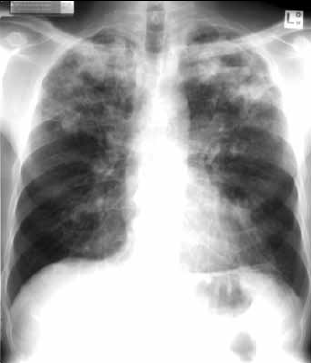 Figure 2. Chest X-ray of a man, 47 years of age, with typical pulmonary tuberculosis