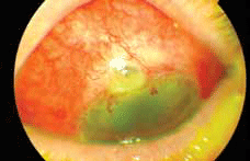 Figure 2. Infected trabeculectomy bleb at the superior limbus