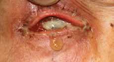 Figure 3. Severe intra-ocular infection and corneal perforation following intravitreal ranibizumab injection