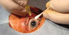 Figure 4. Method of intravitreal injection. A speculum is inserted. Most commonly performed with topical (+/- subconjunctival) anaesthetic