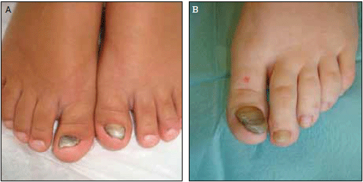 Clinical appearance of the patients' great toenails