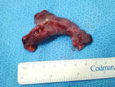 Left fallopian tube and ectopic products of conception