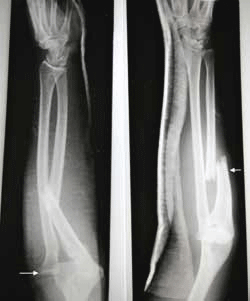 Figure 1. X-ray of the patient's forearm