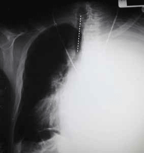 Figure 11. The patient's AP chest X-ray