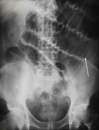 Figure 13. The patient's supine abdominal X-ray