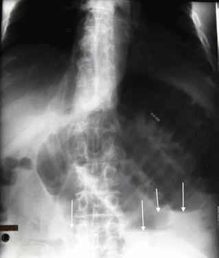 Figure 14. The patient's erect abdominal X-ray