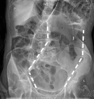 Figure 15. The patient's supine abdominal X-ray