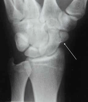 Figure 2. X-ray of the patient's wrist