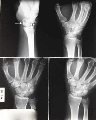 Figure 3. Wrist X-ray in a different patient