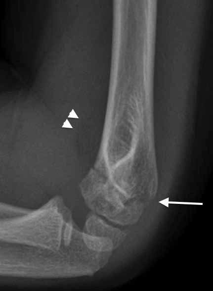 Figure 5. X-ray of the patient's elbow