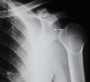 Figure 6. AP view of the patient's shoulder