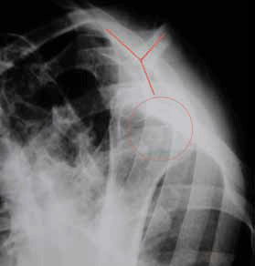 Figure 7. Lateral view of the patient's shoulder