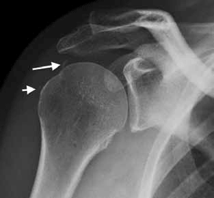 Figure 9. X-ray of the patient's shoulder