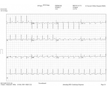 Figure 2. Peak stress electrocardiogram