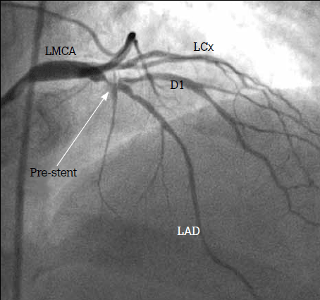 Figure 4. Angiogram showing severe bifurcating stenosis involving the proximal LAD and its first diagonal branch
