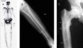 Figure 1. Radiological features of Paget disease of bone