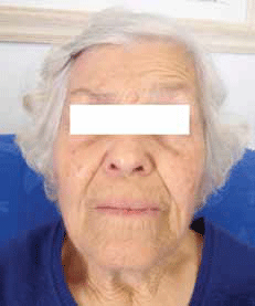 Figure 1. Patient with right facial nerve palsy