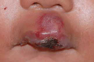 Figure 2. Ulcerated infantile haemangioma involving central upper lip before treatment