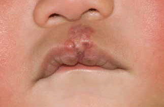 Figure 3. Infantile haemangioma involving central upper lip after treatment with prednisolone and propranolol for 4 months