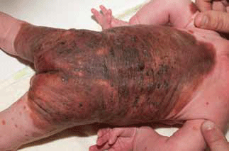 Figure 6. Large congenital melanocytic naevus with a truncal distribution and satellite naevi