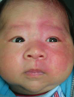 Reddened area on face, present at birth