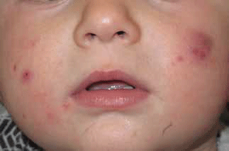 Figure 4. Infantile acne with comedones, papules, pustules and cysts