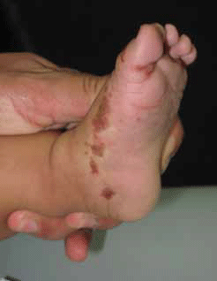 Figure 5. Acropustulosis with resolving papules and pustules